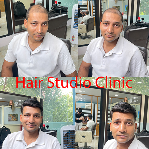 Best Hair Patch Service in Delhi Best Hair Patch Service in Delhi