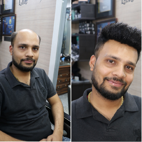 Hair Replacement Service Hair Replacement Service